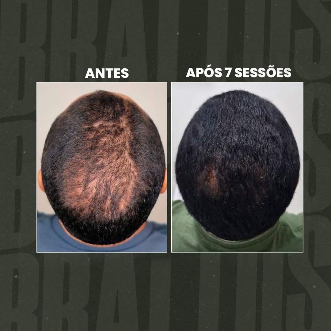 estética masculina, terapia capilar masculina, tratamento para calvície, queda de cabelo homem, depilação a LED masculina, botox masculino, harmonização facial masculina, protocolo de emagrecimento masculino, tratamento capilar para homens, estética para homens, clínica estética masculina, cuidados com a aparência masculina, tratamento para entradas no cabelo, performance corporal masculina, autoestima masculina