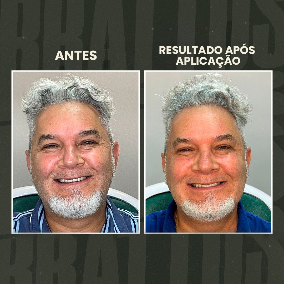estética masculina, terapia capilar masculina, tratamento para calvície, queda de cabelo homem, depilação a LED masculina, botox masculino, harmonização facial masculina, protocolo de emagrecimento masculino, tratamento capilar para homens, estética para homens, clínica estética masculina, cuidados com a aparência masculina, tratamento para entradas no cabelo, performance corporal masculina, autoestima masculina