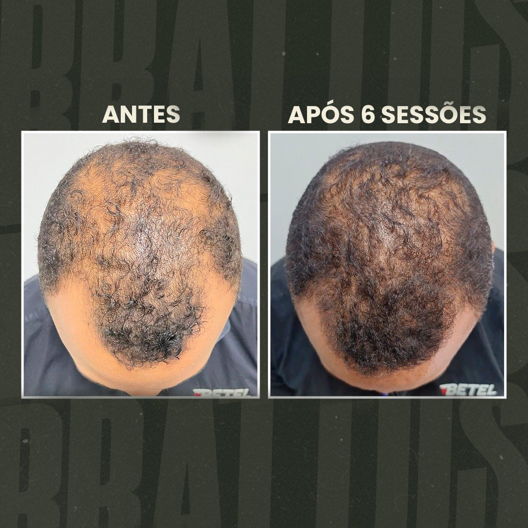 estética masculina, terapia capilar masculina, tratamento para calvície, queda de cabelo homem, depilação a LED masculina, botox masculino, harmonização facial masculina, protocolo de emagrecimento masculino, tratamento capilar para homens, estética para homens, clínica estética masculina, cuidados com a aparência masculina, tratamento para entradas no cabelo, performance corporal masculina, autoestima masculina