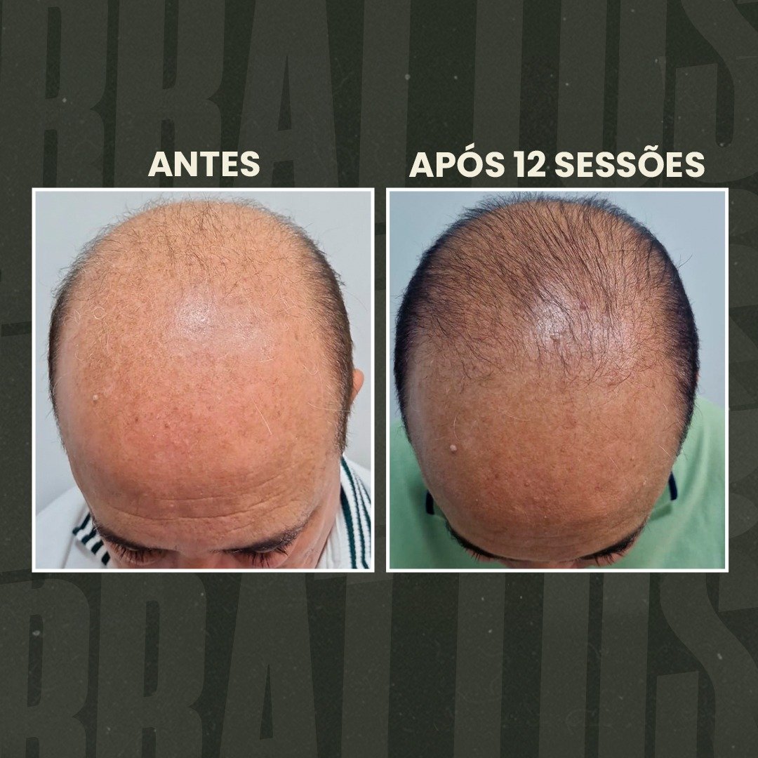 estética masculina, terapia capilar masculina, tratamento para calvície, queda de cabelo homem, depilação a LED masculina, botox masculino, harmonização facial masculina, protocolo de emagrecimento masculino, tratamento capilar para homens, estética para homens, clínica estética masculina, cuidados com a aparência masculina, tratamento para entradas no cabelo, performance corporal masculina, autoestima masculina