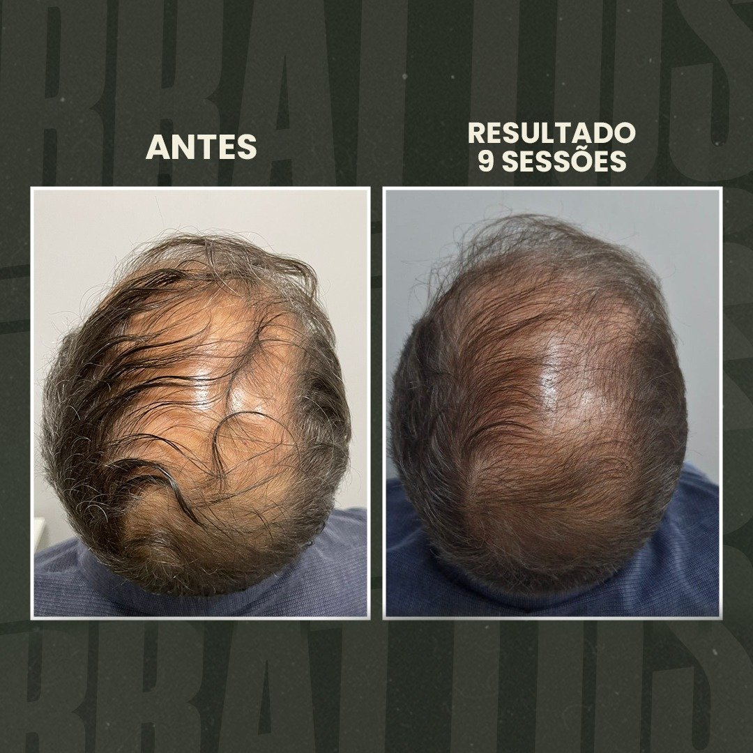 estética masculina, terapia capilar masculina, tratamento para calvície, queda de cabelo homem, depilação a LED masculina, botox masculino, harmonização facial masculina, protocolo de emagrecimento masculino, tratamento capilar para homens, estética para homens, clínica estética masculina, cuidados com a aparência masculina, tratamento para entradas no cabelo, performance corporal masculina, autoestima masculina